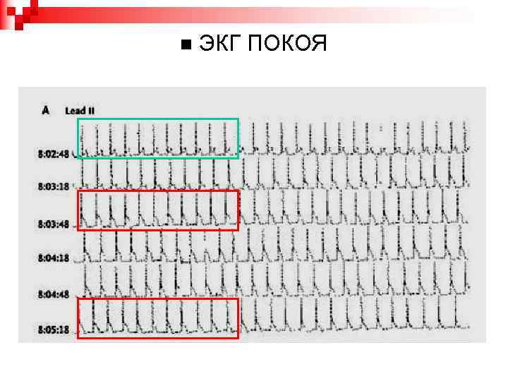 Экг в покое