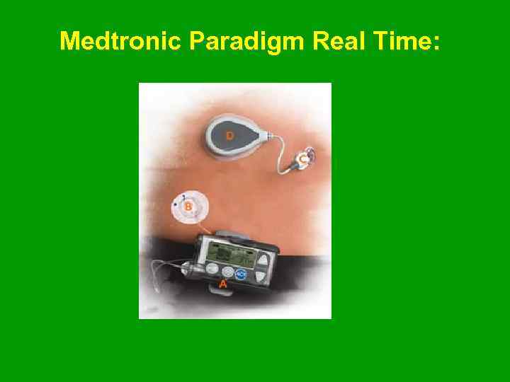 Medtronic Paradigm Real Time: 