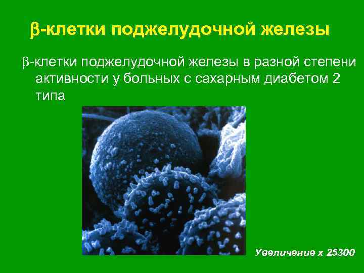  -клетки поджелудочной железы в разной степени активности у больных с сахарным диабетом 2