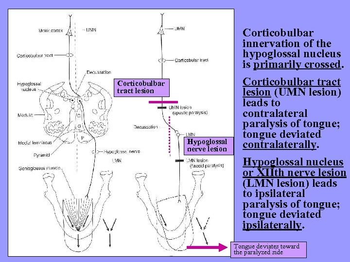 Corticobulbar tract lesion Hypoglossal nerve lesion Corticobulbar innervation of the hypoglossal nucleus is primarily