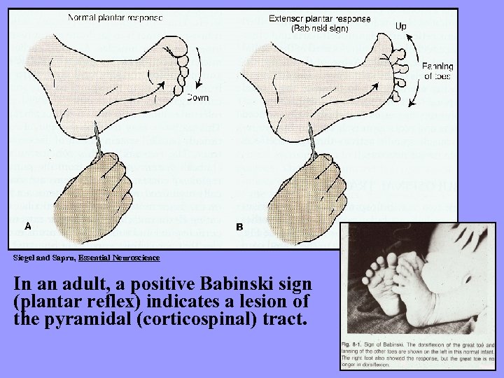 Siegel and Sapru, Essential Neuroscience In an adult, a positive Babinski sign (plantar reflex)