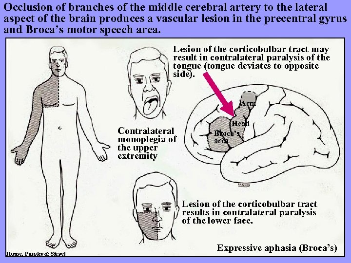 Occlusion of branches of the middle cerebral artery to the lateral aspect of the