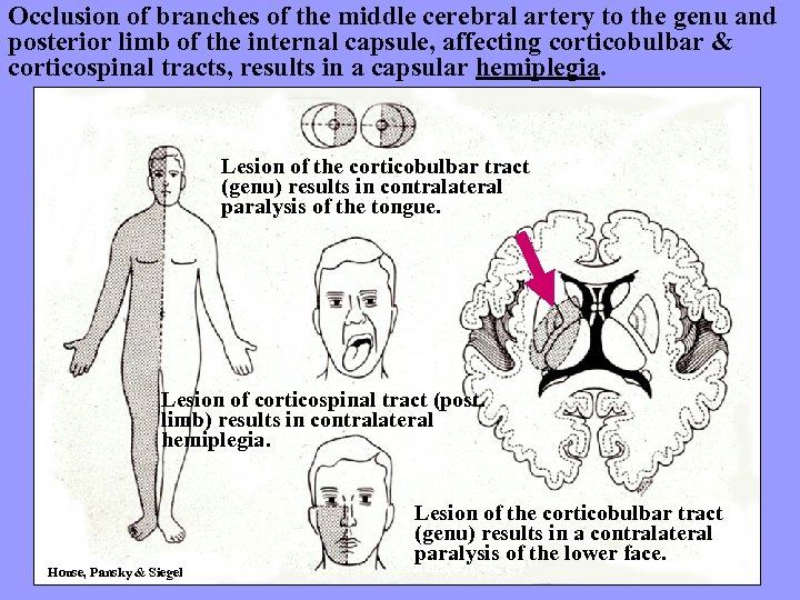 Occlusion of branches of the middle cerebral artery to the genu and posterior limb