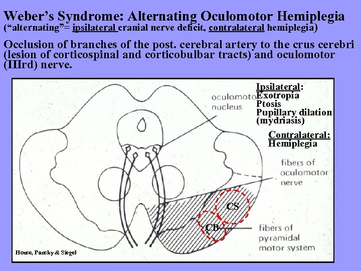 Weber’s Syndrome: Alternating Oculomotor Hemiplegia (“alternating”= ipsilateral cranial nerve deficit, contralateral hemiplegia) Occlusion of