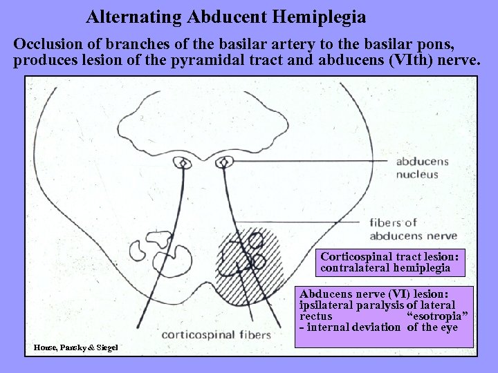 Alternating Abducent Hemiplegia Occlusion of branches of the basilar artery to the basilar pons,