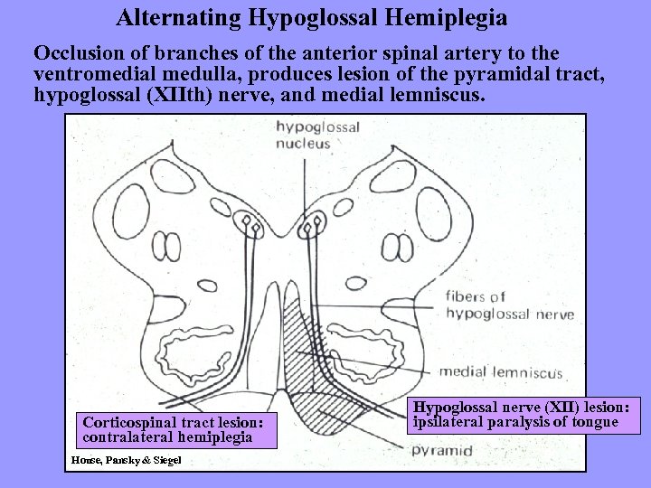 Alternating Hypoglossal Hemiplegia Occlusion of branches of the anterior spinal artery to the ventromedial