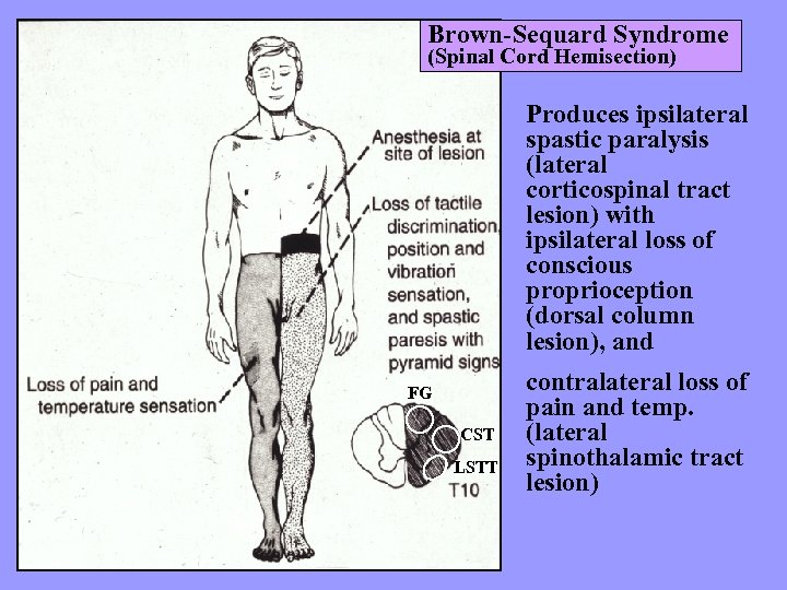 Brown-Sequard Syndrome (Spinal Cord Hemisection) Produces ipsilateral spastic paralysis (lateral corticospinal tract lesion) with