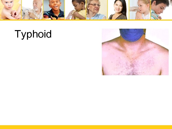 Typhoid 