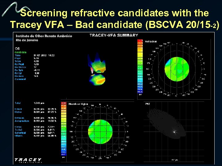 Screening refractive candidates with the Tracey VFA – Bad candidate (BSCVA 20/15 -2) 