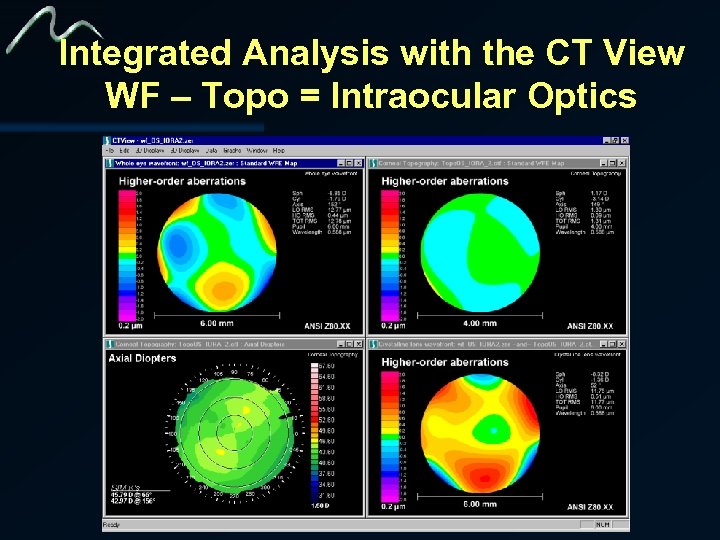 Integrated Analysis with the CT View WF – Topo = Intraocular Optics 