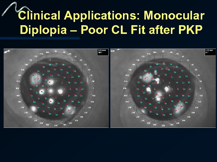 Clinical Applications: Monocular Diplopia – Poor CL Fit after PKP 