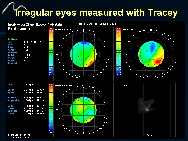 Irregular eyes measured with Tracey Instituto de Olhos Renato Ambrósio Rio de Janeiro 