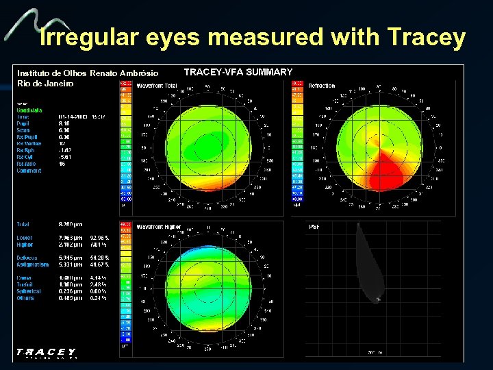 Irregular eyes measured with Tracey Instituto de Olhos Renato Ambrósio Rio de Janeiro 
