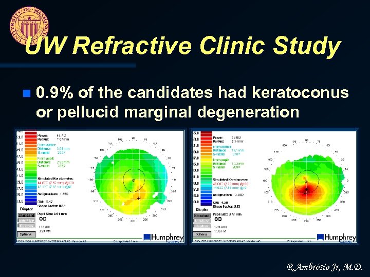UW Refractive Clinic Study n 0. 9% of the candidates had keratoconus or pellucid