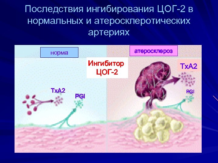 Последствия ингибирования ЦОГ-2 в нормальных и атеросклеротических артериях атеросклероз норма Ингибитор ЦОГ-2 Tx. A