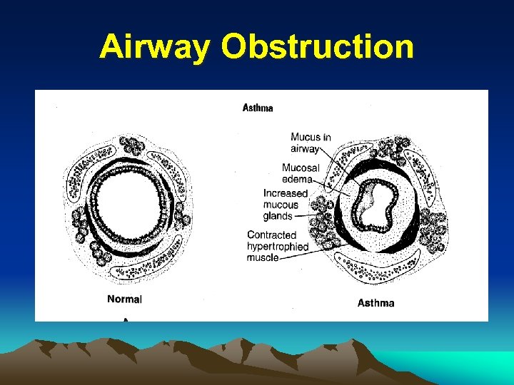 Airway Obstruction 