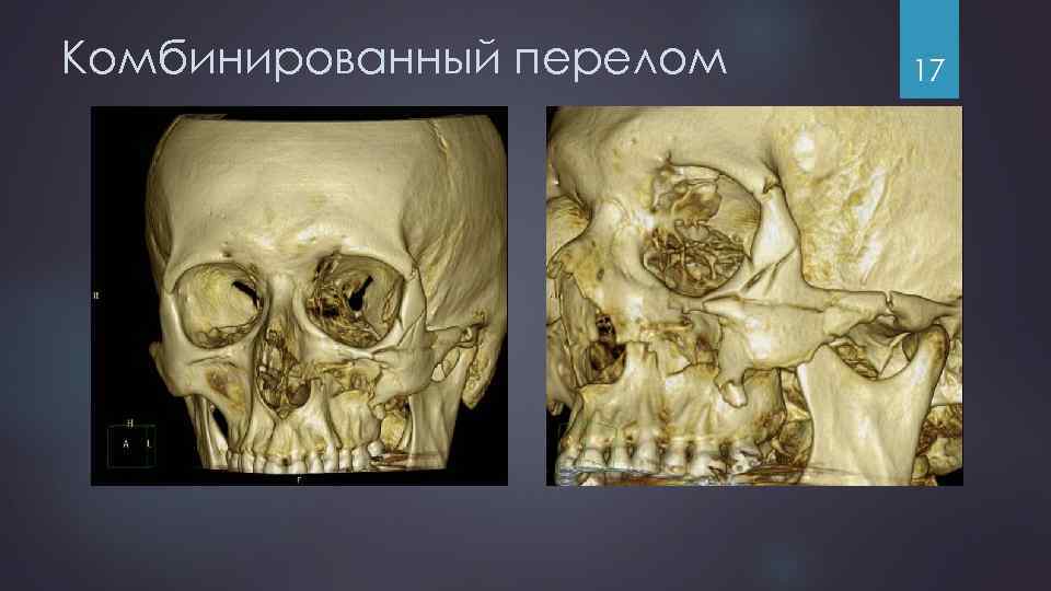 Комбинированный перелом 17 