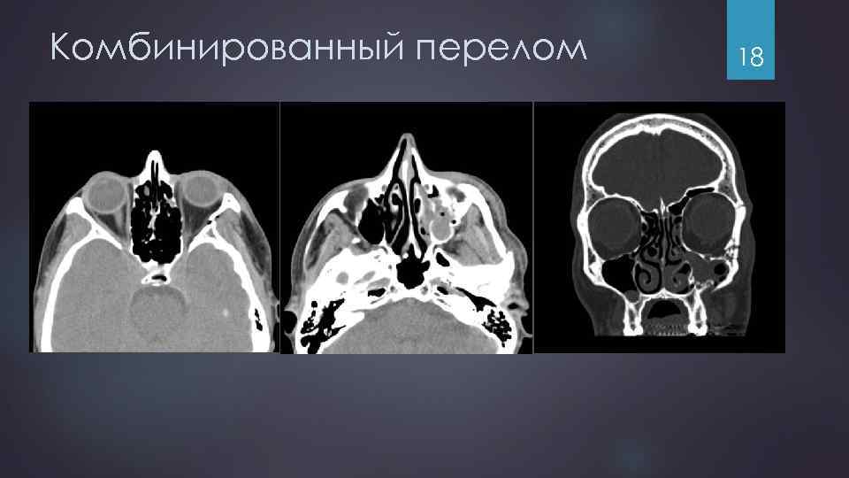 Комбинированный перелом 18 