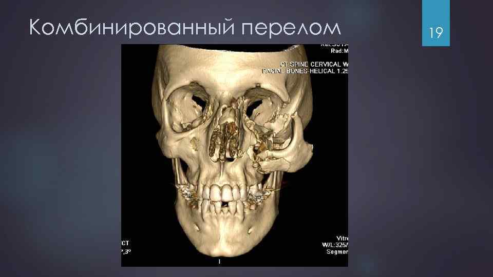 Комбинированный перелом 19 