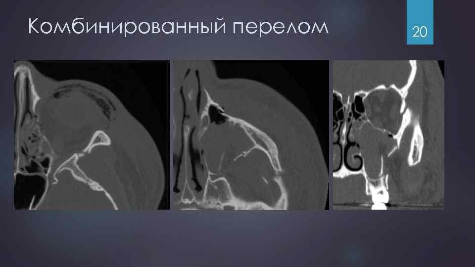 Комбинированный перелом 20 