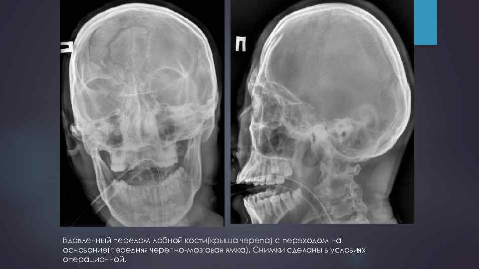Вдавленный перелом лобной кости(крыша черепа) с переходом на основание(передняя черепно-мозговая ямка). Снимки сделаны в
