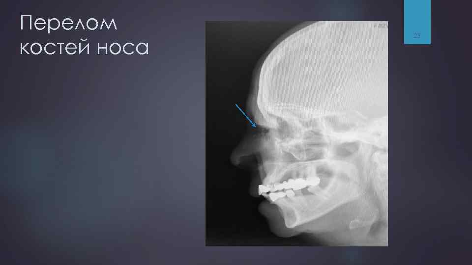 Перелом костей носа 23 