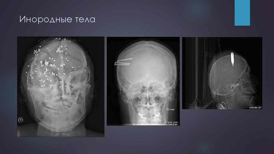 Инородные тела 