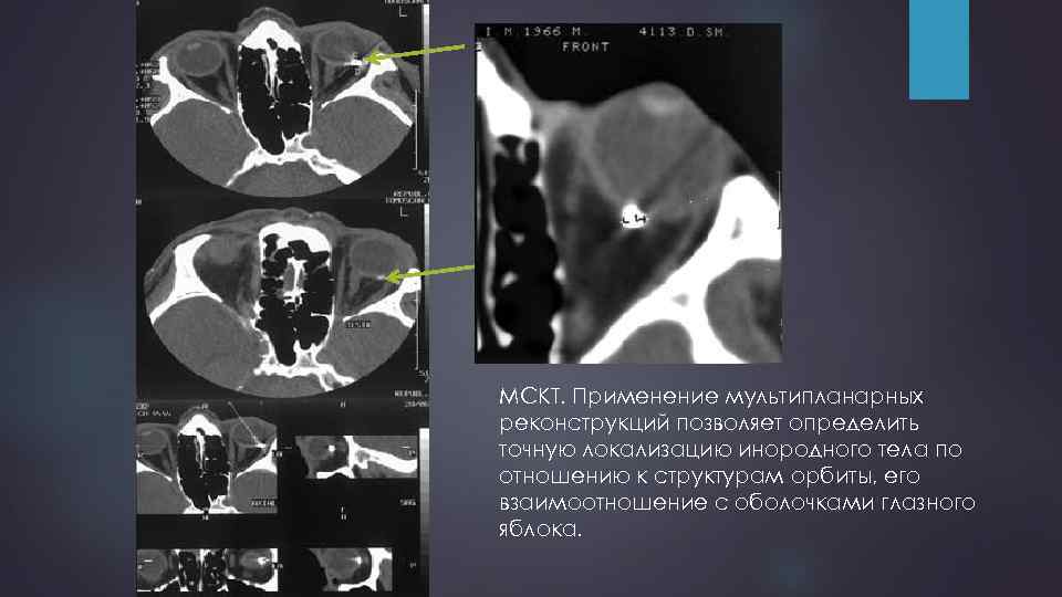 МСКТ. Применение мультипланарных реконструкций позволяет определить точную локализацию инородного тела по отношению к структурам