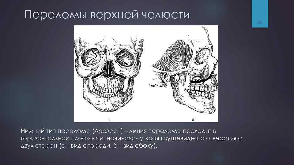 Переломы верхней челюсти Нижний тип перелома (Лефор I) – линия перелома проходит в горизонтальной