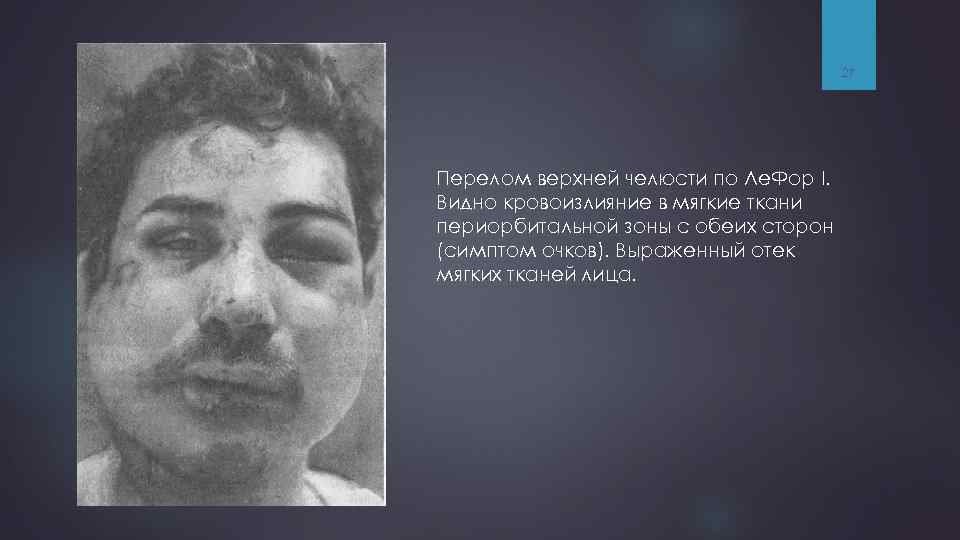 27 Перелом верхней челюсти по Ле. Фор I. Видно кровоизлияние в мягкие ткани периорбитальной