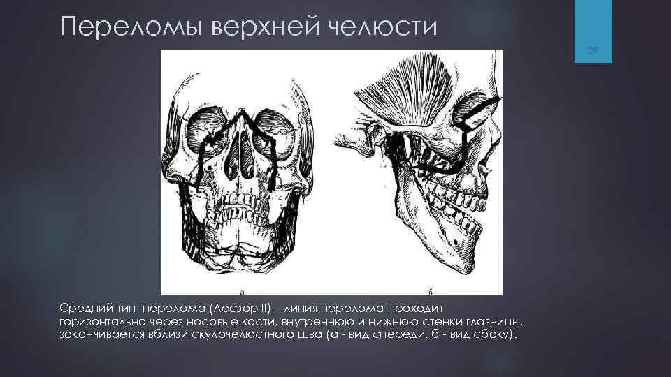 Переломы верхней челюсти 29 Средний тип перелома (Лефор II) – линия перелома проходит горизонтально