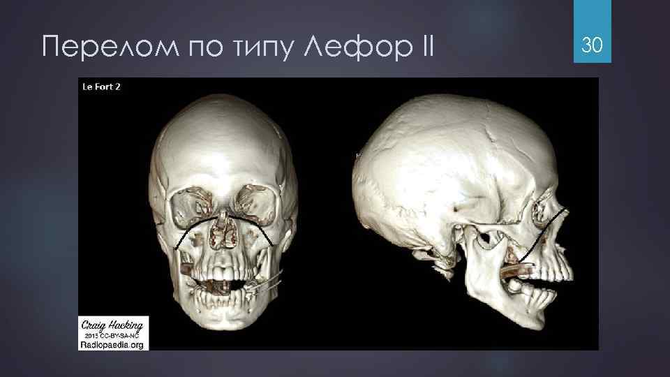 Перелом по типу Лефор II 30 