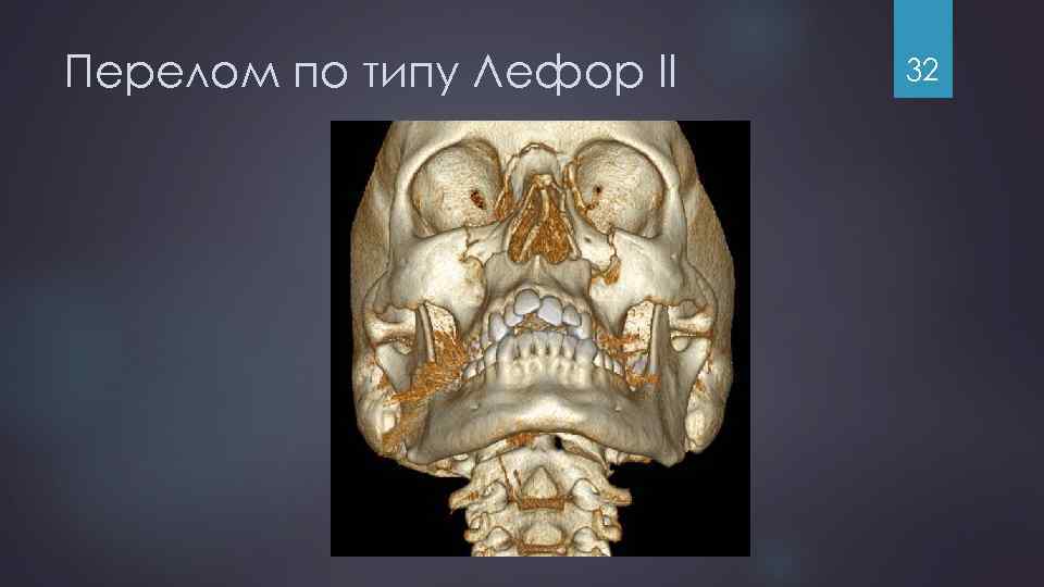 Перелом по типу Лефор II 32 