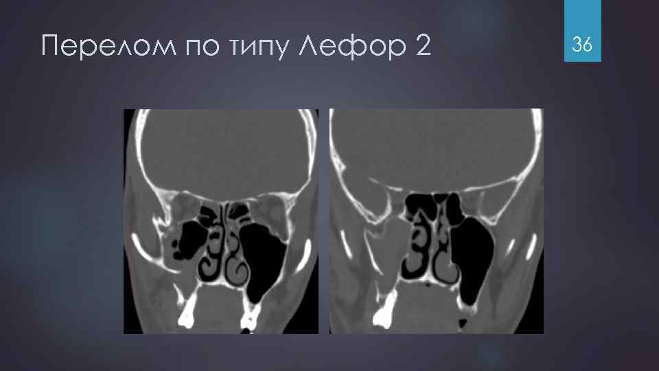 Перелом по типу Лефор 2 36 