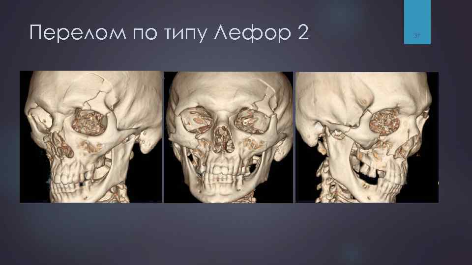 Перелом по типу Лефор 2 37 