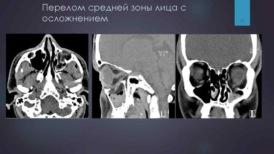 Перелом средней зоны лица с осложнением 40 