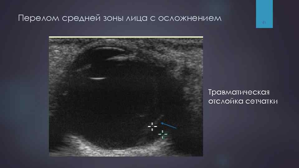 Перелом средней зоны лица с осложнением 41 Травматическая отслойка сетчатки 