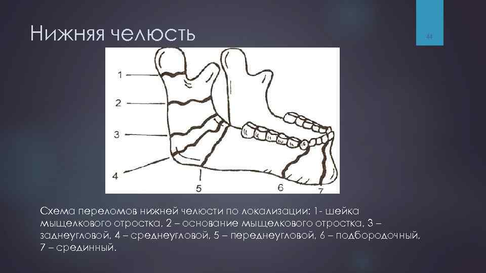 Нижняя челюсть Схема переломов нижней челюсти по локализации: 1 - шейка мыщелкового отростка, 2