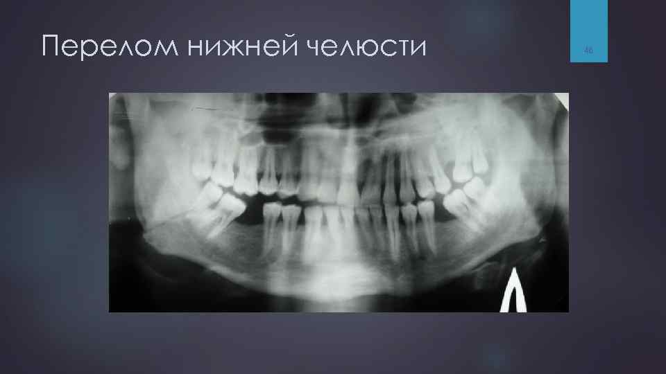 Перелом нижней челюсти 46 