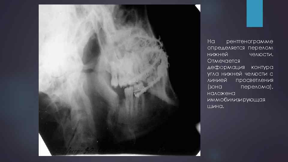 На рентгенограмме определяется перелом нижней челюсти. Отмечается деформация контура угла нижней челюсти с линией
