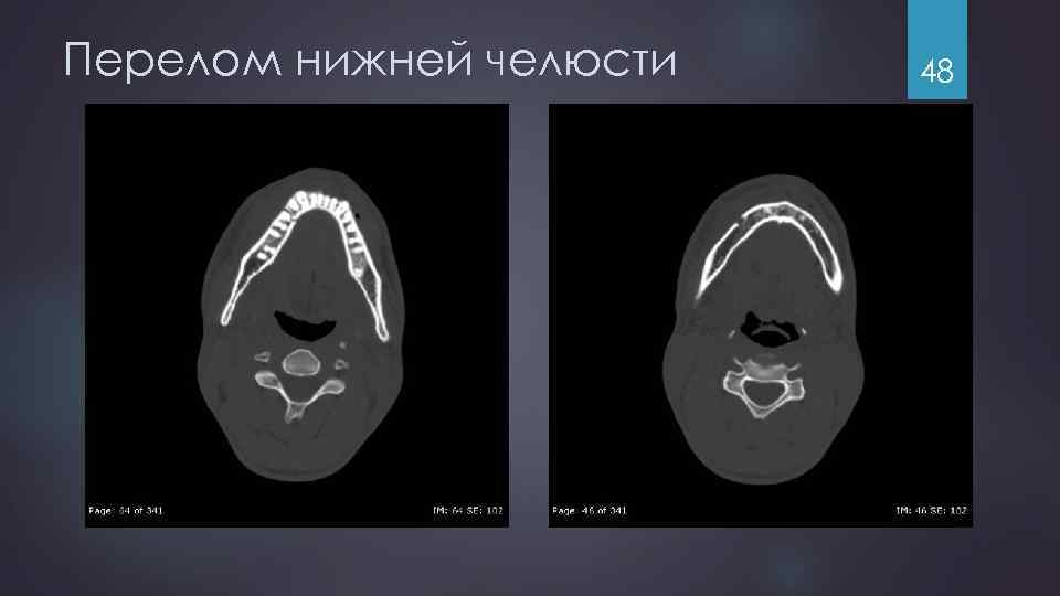 Перелом нижней челюсти 48 