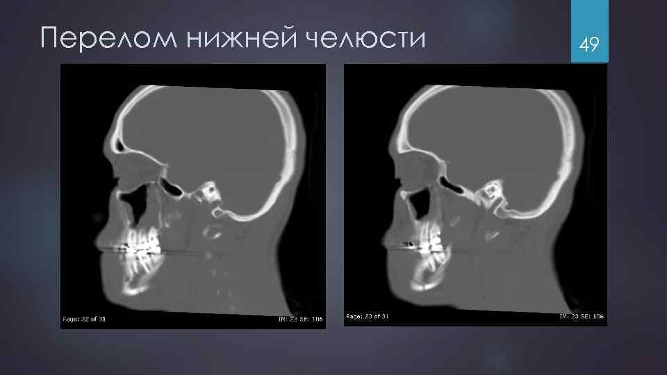Перелом нижней челюсти 49 