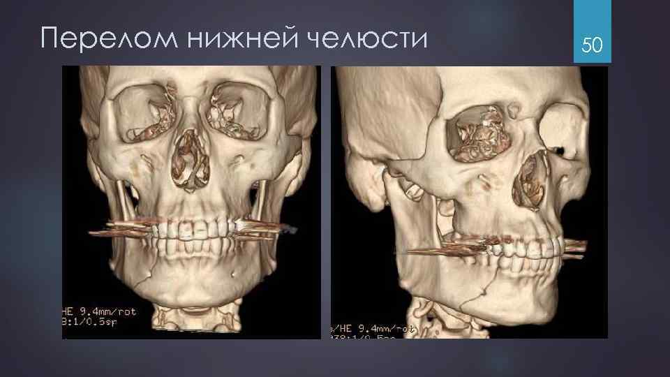 Перелом нижней челюсти 50 