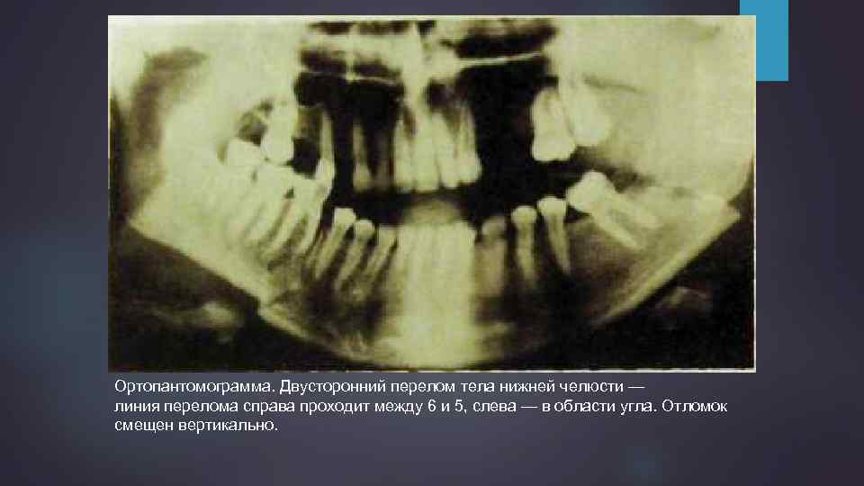 Ортопантомограмма. Двусторонний перелом тела нижней челюсти — линия перелома справа проходит между 6 и