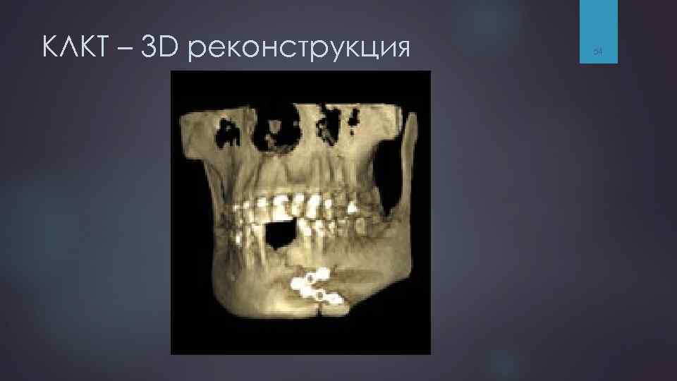 КЛКТ – 3 D реконструкция 54 