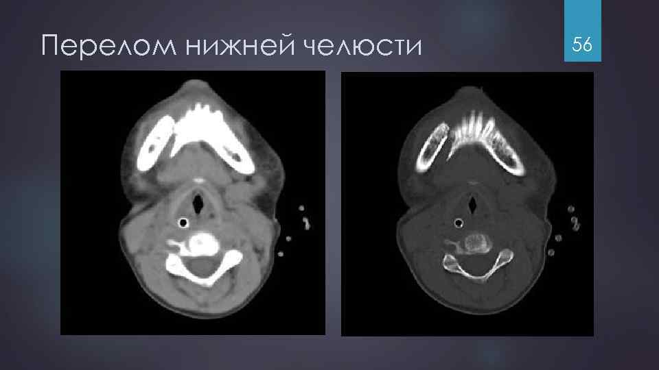 Перелом нижней челюсти 56 