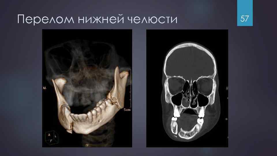 Перелом нижней челюсти 57 