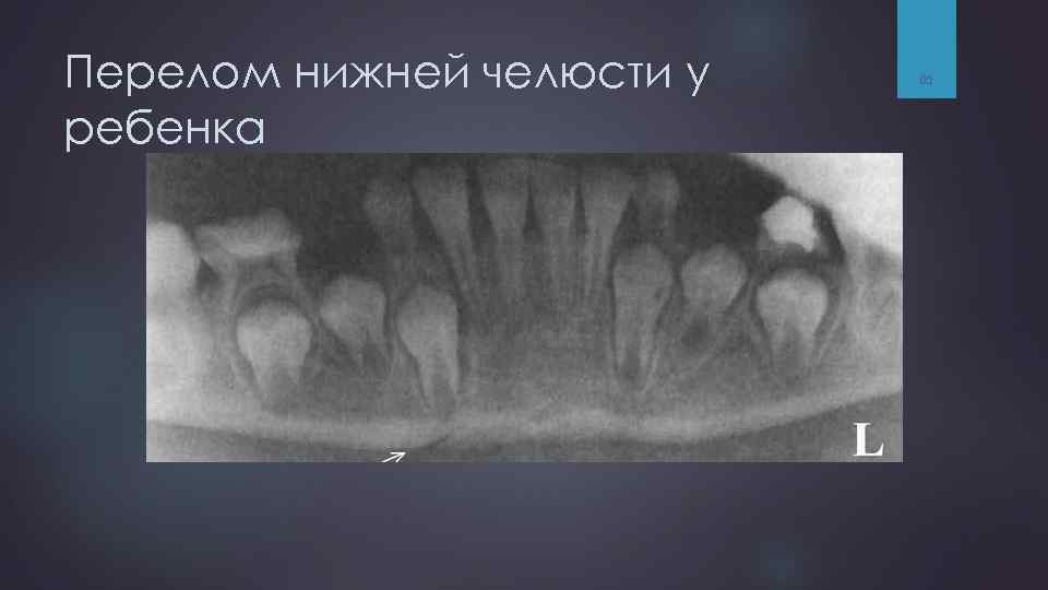 Перелом нижней челюсти у ребенка 65 