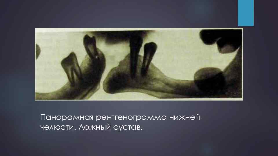 Панорамная рентгенограмма нижней челюсти. Ложный сустав. 
