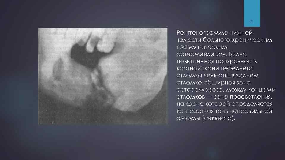 71 Рентгенограмма нижней челюсти больного хроническим травматическим остеомиелитом. Видна повышенная прозрачность костной ткани переднего